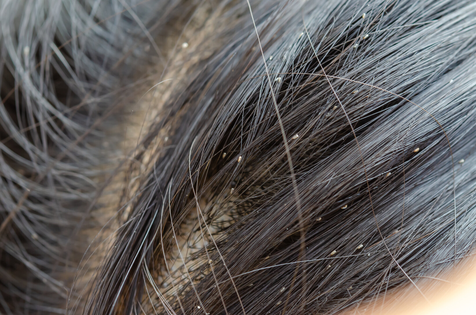 Head Lice How To Recognise An Infestation And Treat It Your 